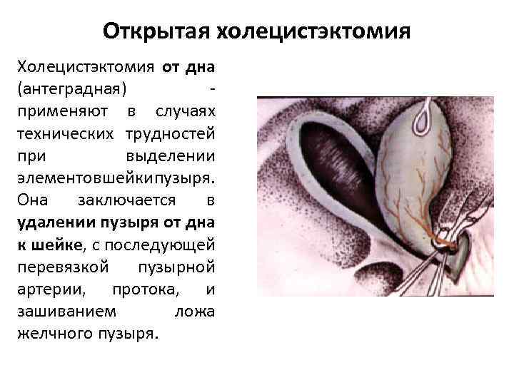 Открытая холецистэктомия Холецистэктомия от дна (антеградная) - применяют в случаях технических трудностей при выделении