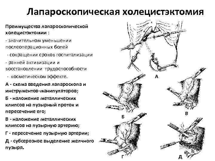 Лапароскопическая холецистэктомия Преимущества лапароскопической холецистэктомии : - значительном уменьшении послеоперационных болей - сокращении сроков