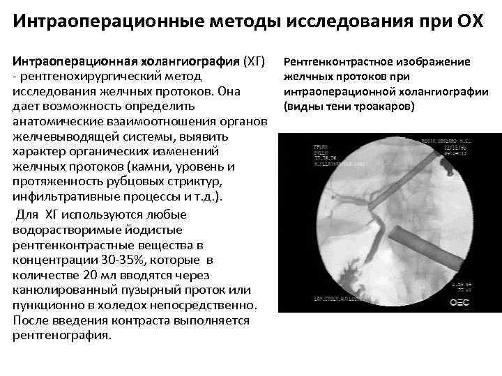 Интраоперационные методы исследования при ОХ Интраоперационная холангиография (ХГ) - рентгенохирургический метод исследования желчных протоков.