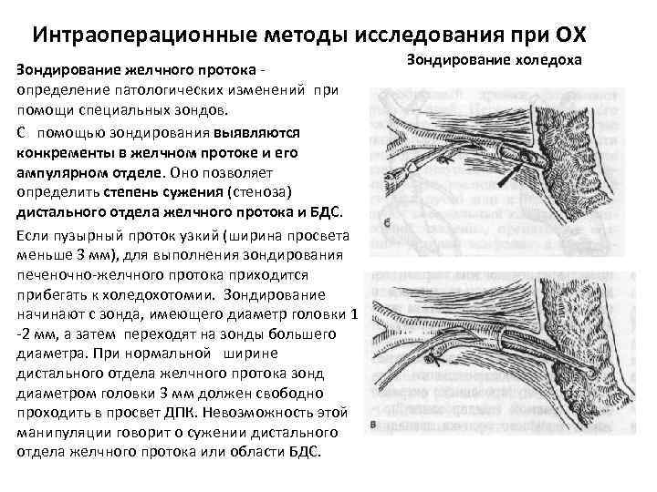 Интраоперационные методы исследования при ОХ Зондирование желчного протока - определение патологических изменений при помощи