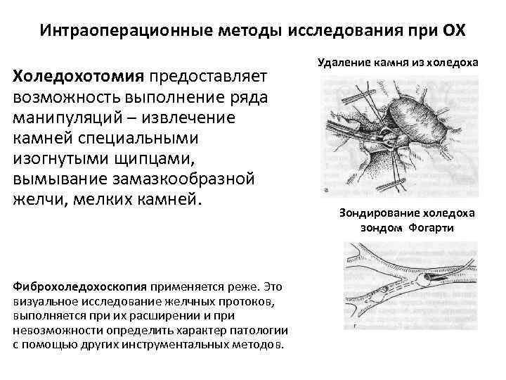 Интраоперационные методы исследования при ОХ Холедохотомия предоставляет возможность выполнение ряда манипуляций – извлечение камней