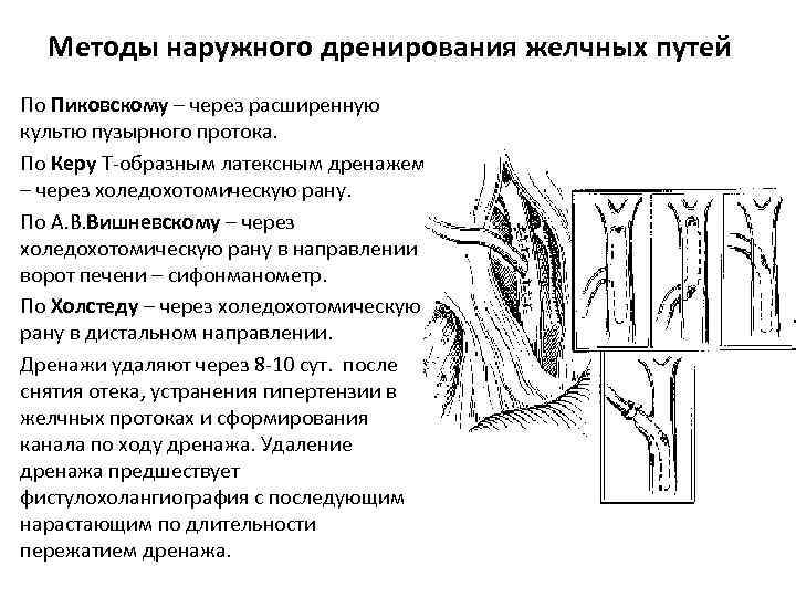 Методы наружного дренирования желчных путей По Пиковскому – через расширенную культю пузырного протока. По