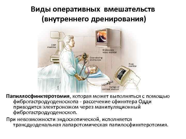 Виды оперативных вмешательств (внутреннего дренирования) Папиллосфинктеротомия, которая может выполняться с помощью фиброгастродуоденоскопа - рассечение