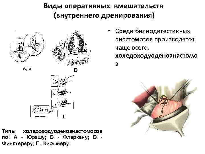 Виды оперативных вмешательств (внутреннего дренирования) А, Б В Г Типы холедоходуоденоанастомозов по: А -