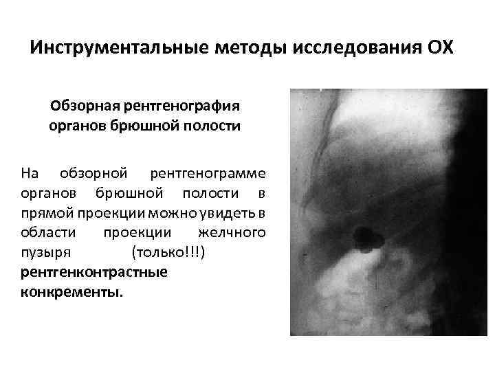 Инструментальные методы исследования ОХ Обзорная рентгенография органов брюшной полости На обзорной рентгенограмме органов брюшной