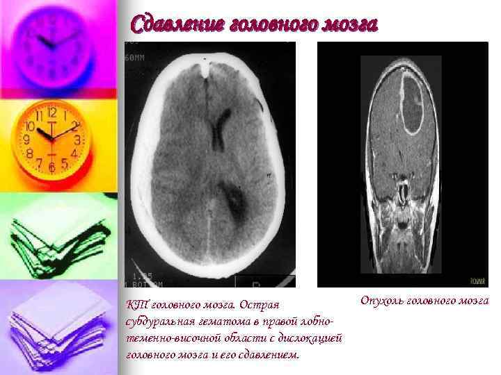 Сдавление головного мозга КТ головного мозга. Острая субдуральная гематома в правой лобнотеменно-височной области с