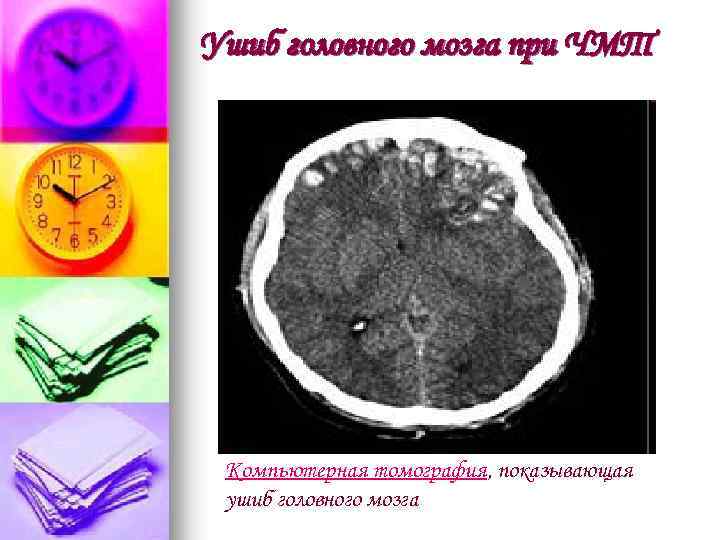 Ушиб головного мозга при ЧМТ Компьютерная томография, показывающая ушиб головного мозга 