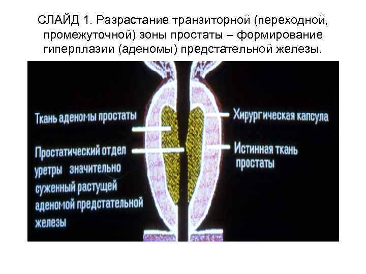 СЛАЙД 1. Разрастание транзиторной (переходной, промежуточной) зоны простаты – формирование гиперплазии (аденомы) предстательной железы.