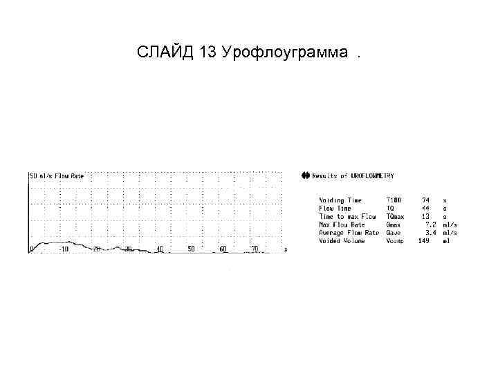 СЛАЙД 13 Урофлоуграмма. 