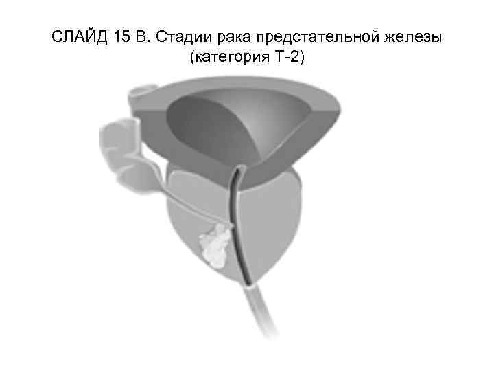 СЛАЙД 15 В. Стадии рака предстательной железы (категория Т-2) 