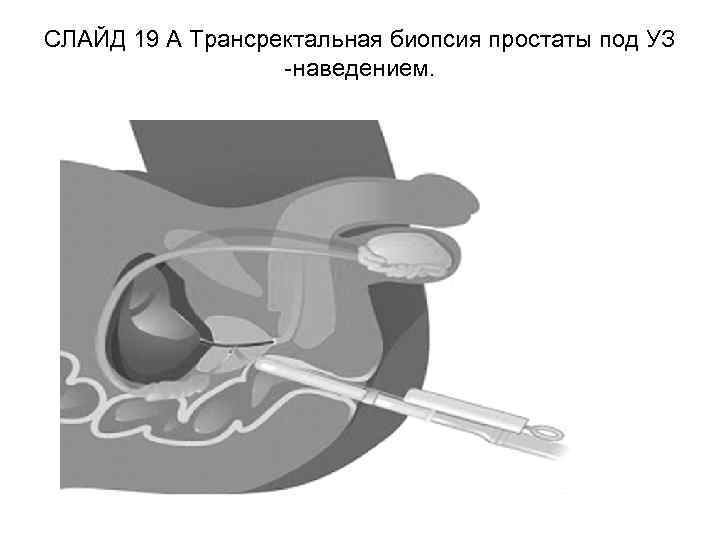 СЛАЙД 19 A Трансректальная биопсия простаты под УЗ -наведением. 