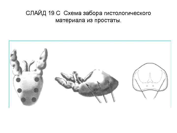 СЛАЙД 19 C Схема забора гистологического материала из простаты. 