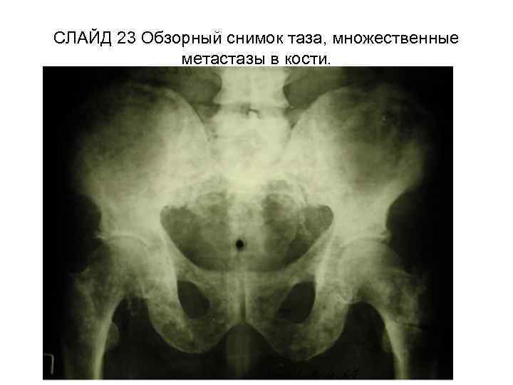 СЛАЙД 23 Обзорный снимок таза, множественные метастазы в кости. 