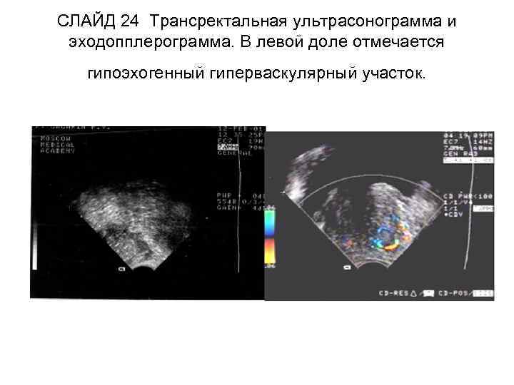 СЛАЙД 24 Трансректальная ультрасонограмма и эходопплерограмма. В левой доле отмечается гипоэхогенный гиперваскулярный участок. 