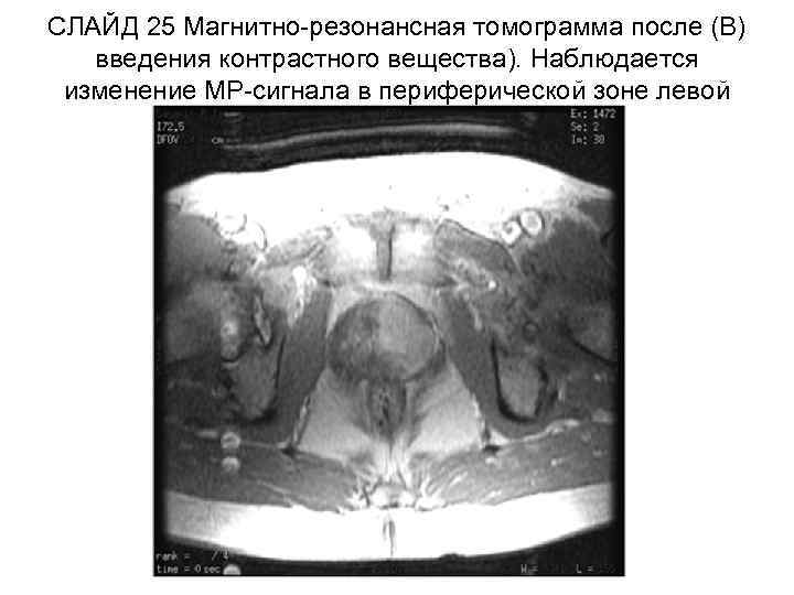 СЛАЙД 25 Магнитно-резонансная томограмма после (В) введения контрастного вещества). Наблюдается изменение МР-сигнала в периферической