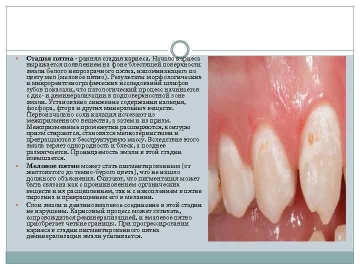  Стадия пятна - ранняя стадия кариеса. Начало кариеса выражается появлением на фоне блестящей