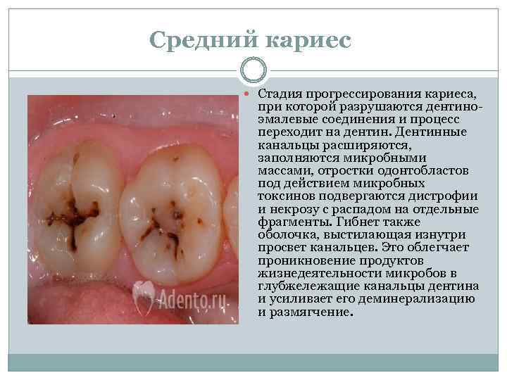 Средний кариес Стадия прогрессирования кариеса, при которой разрушаются дентиноэмалевые соединения и процесс переходит на