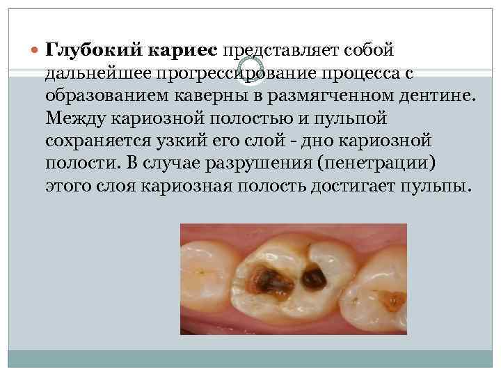  Глубокий кариес представляет собой дальнейшее прогрессирование процесса с образованием каверны в размягченном дентине.