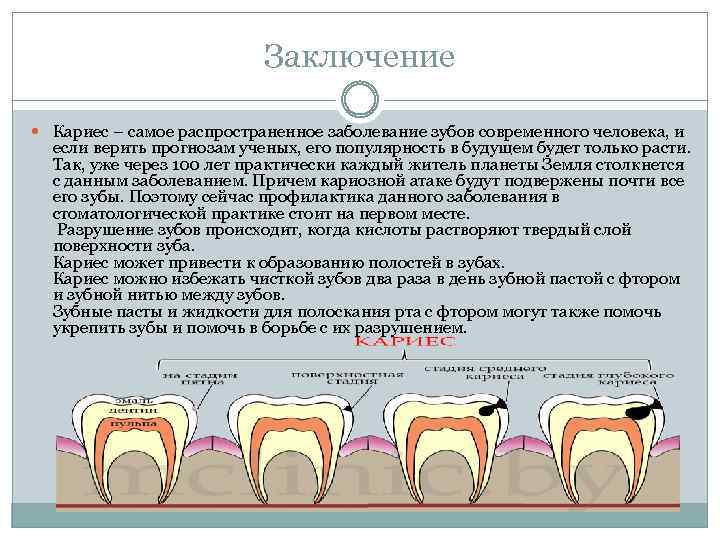 Заболевания зубов и полости. Стадии образования кариеса. Поражение зубов кариесом.