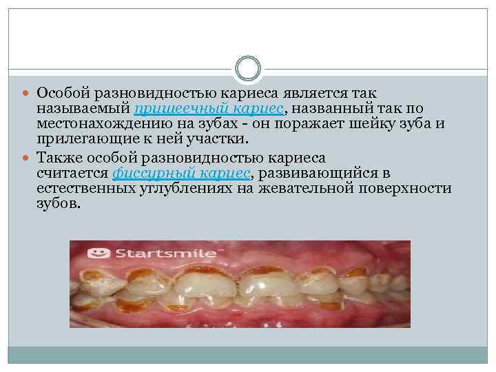  Особой разновидностью кариеса является так называемый пришеечный кариес, названный так по местонахождению на