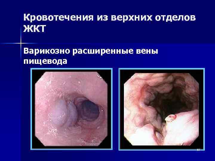 Кровотечения из верхних отделов ЖКТ Варикозно расширенные вены пищевода 64 