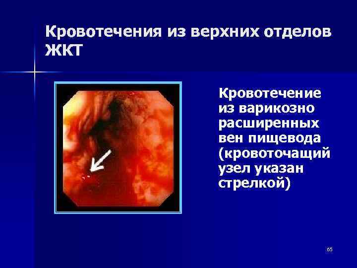 Кровотечения из верхних отделов ЖКТ Кровотечение из варикозно расширенных вен пищевода (кровоточащий узел указан