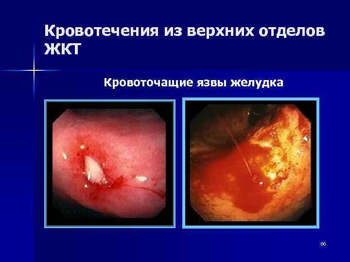 Кровотечения из верхних отделов ЖКТ Кровоточащие язвы желудка 66 