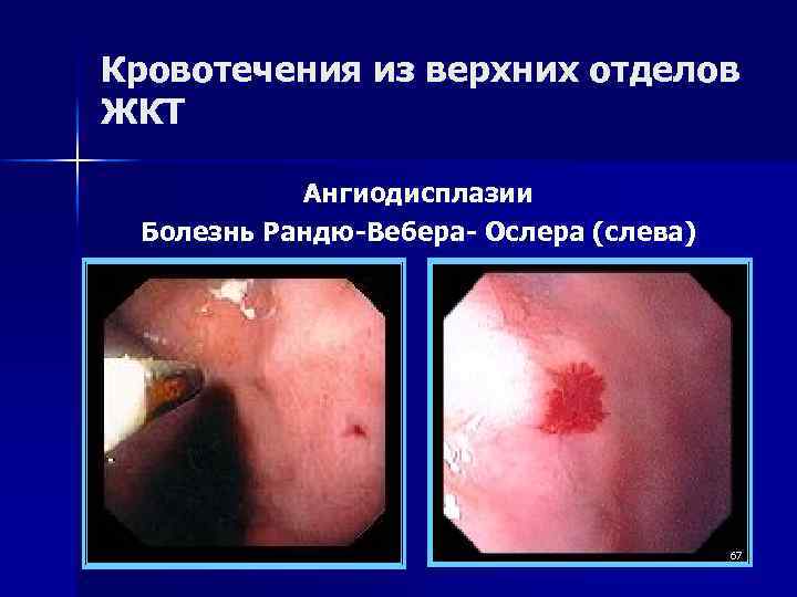 Кровотечения из верхних отделов ЖКТ Ангиодисплазии Болезнь Рандю-Вебера- Ослера (слева) 67 