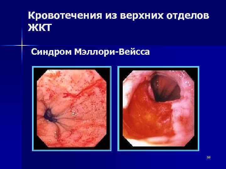 Кровотечения из верхних отделов ЖКТ Синдром Мэллори-Вейсса 68 