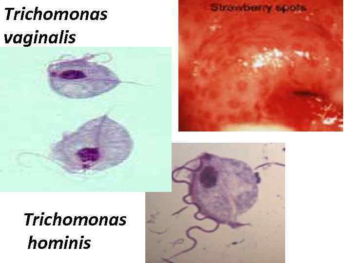 Trichomonas vaginalis Trichomonas hominis 