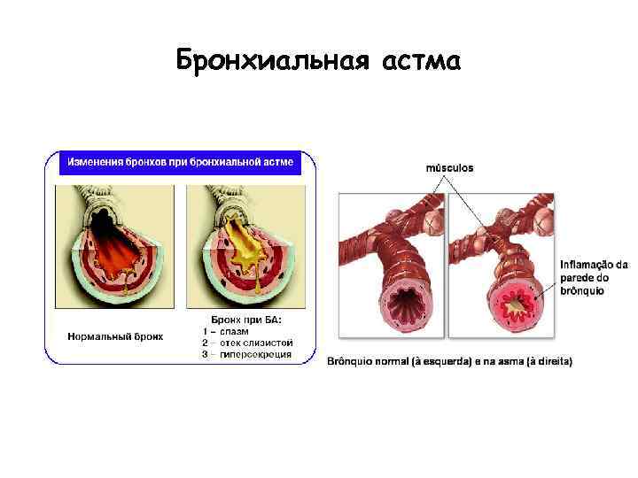 Бронхиальная астма 