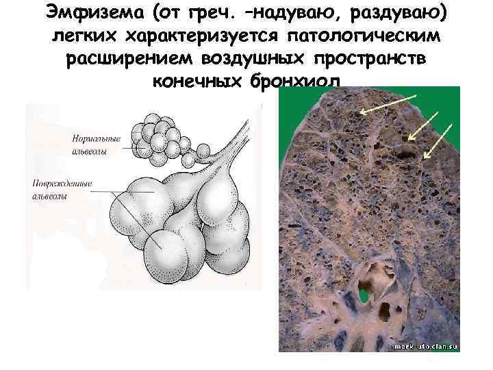 Эмфизема (от греч. –надуваю, раздуваю) легких характеризуется патологическим расширением воздушных пространств конечных бронхиол 