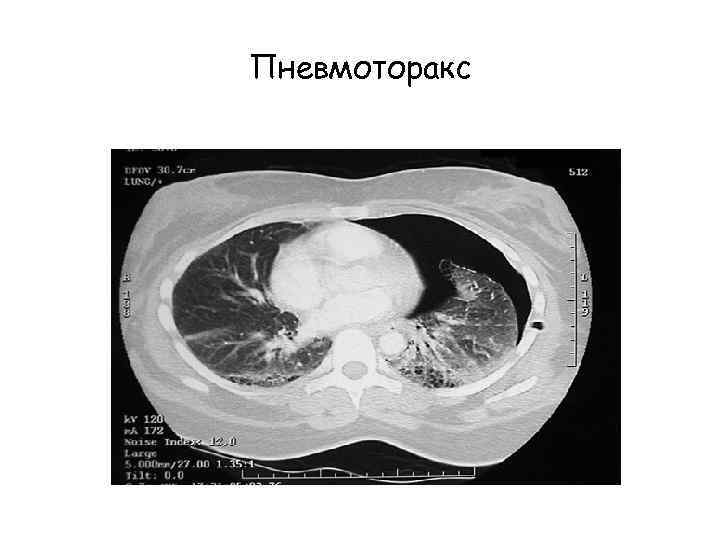 Пневмоторакс 