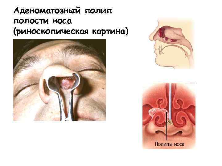 Аденоматозный полип полости носа (риноскопическая картина) 