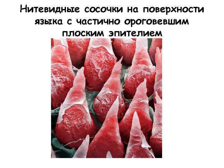 Нитевидные сосочки на поверхности языка с частично ороговевшим плоским эпителием 