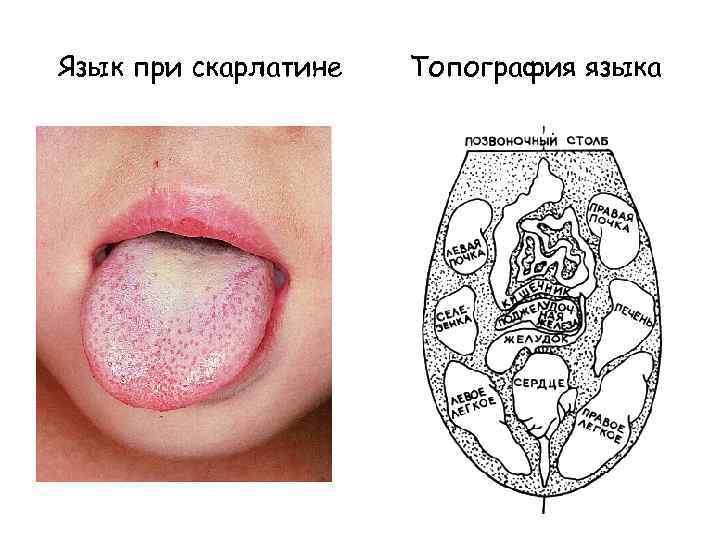 Язык при скарлатине Топография языка 