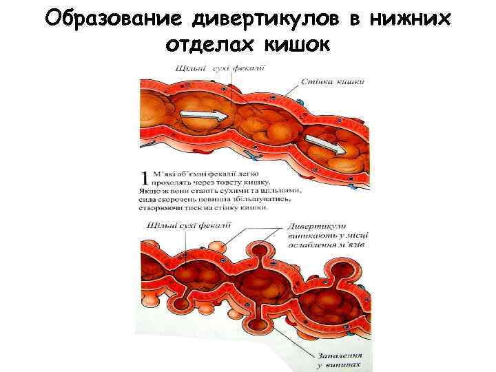 Образование дивертикулов в нижних отделах кишок 