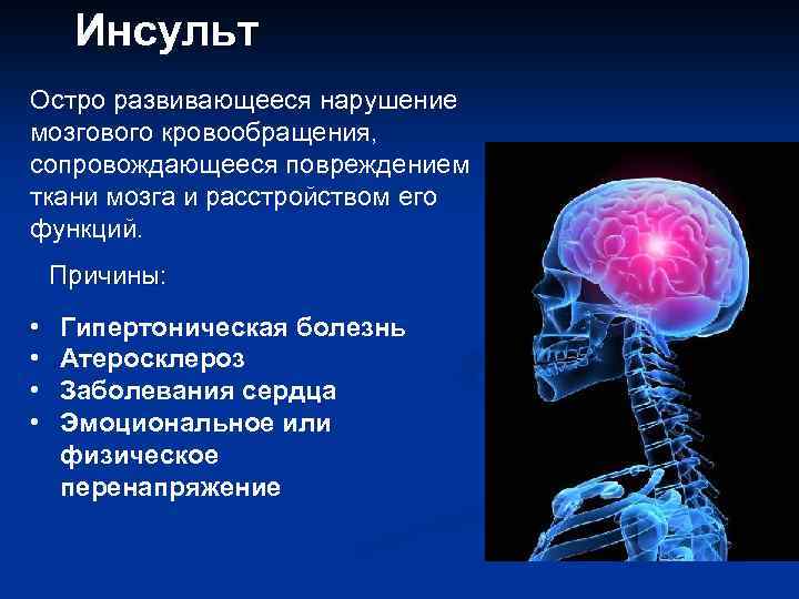 Инсульт Остро развивающееся нарушение мозгового кровообращения, сопровождающееся повреждением ткани мозга и расстройством его функций.