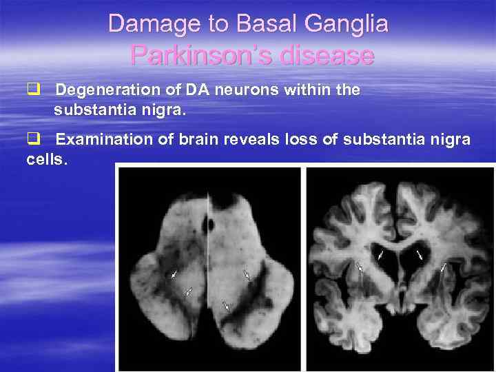 Damage to Basal Ganglia Parkinson’s disease q Degeneration of DA neurons within the substantia