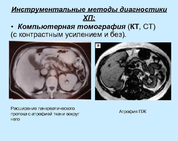 Инструментальные методы диагностики ХП: • Компьютерная томография (КТ, СТ) (с контрастным усилением и без).