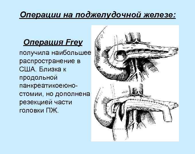 Операции на поджелудочной железе: Операция Frey получила наибольшее распространение в США. Близка к продольной