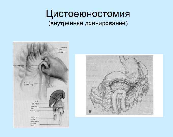 Цистоеюностомия (внутреннее дренирование) 