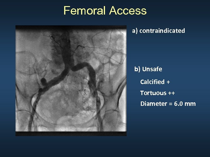 Femoral Access a) contraindicated b) Unsafe Calcified + Tortuous ++ Diameter = 6. 0