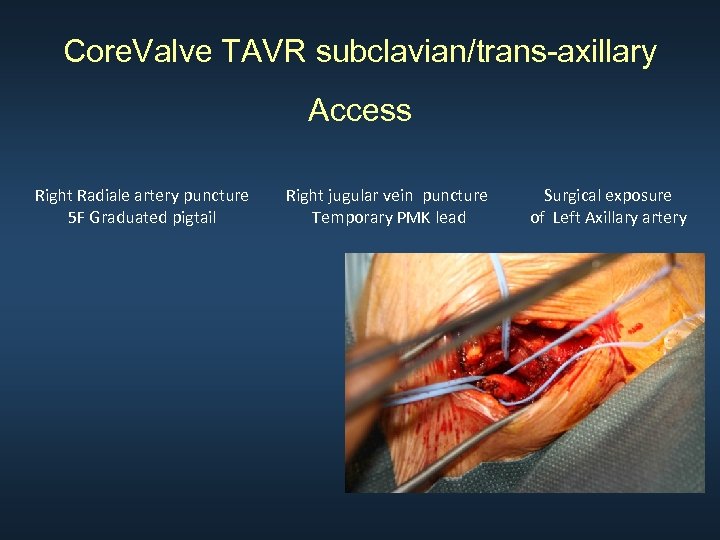 Core. Valve TAVR subclavian/trans-axillary Access Right Radiale artery puncture 5 F Graduated pigtail Right