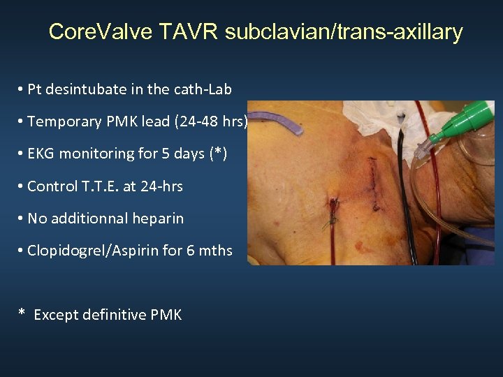Core. Valve TAVR subclavian/trans-axillary • Pt desintubate in the cath-Lab • Temporary PMK lead