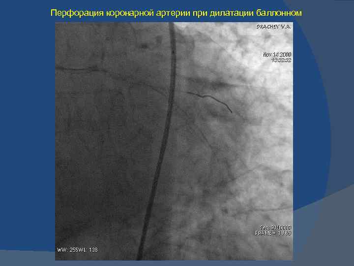 Перфорация коронарной артерии при дилатации баллонном 