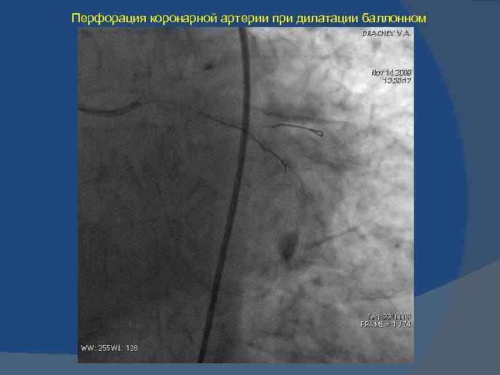 Перфорация коронарной артерии при дилатации баллонном 