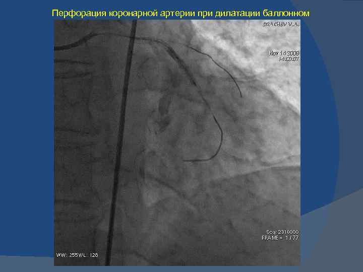 Перфорация коронарной артерии при дилатации баллонном 