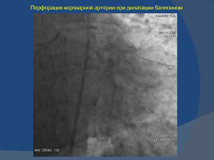 Перфорация коронарной артерии при дилатации баллонном 
