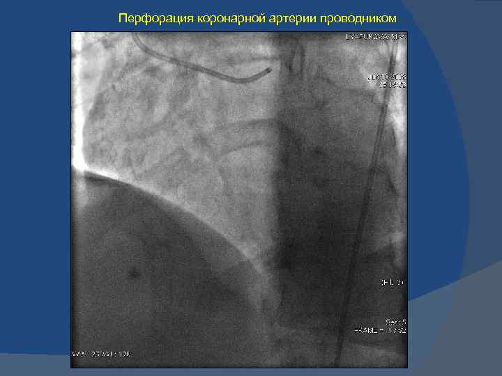 Перфорация коронарной артерии проводником 